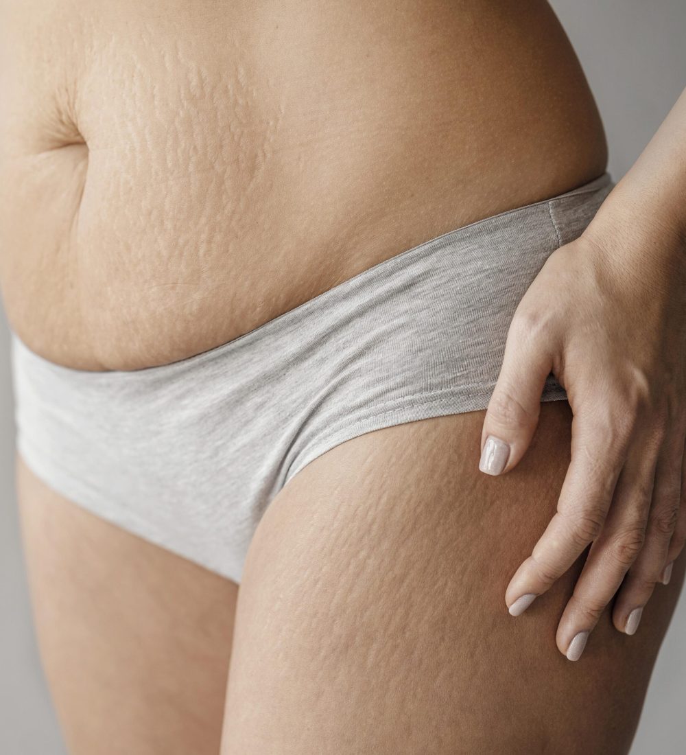 feche-o-corpo-da-mulher-com-estrias